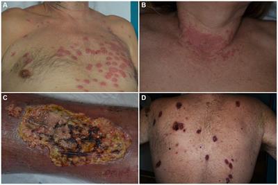 Neutrophilic and eosinophilic dermatoses associated with hematological malignancy